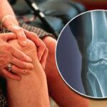 cbdwonderfull-artritis-artrosis