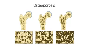 osteoporosis |